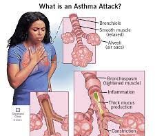 Asthma is different from bronchitis, do not ignore these things