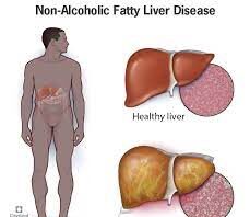 fatty liver